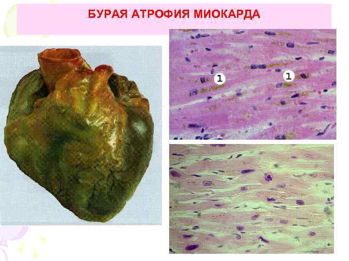 БУРАЯ АТРОФИЯ МИОКАРДА 
