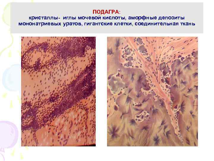 ПОДАГРА: кристаллы- иглы мочевой кислоты, аморфные депозиты мононатриевых уратов, гигантские клетки, соединительная ткань 