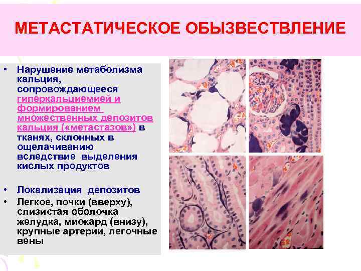 МЕТАСТАТИЧЕСКОЕ ОБЫЗВЕСТВЛЕНИЕ • Нарушение метаболизма кальция, сопровождающееся гиперкальциемией и формированием множественных депозитов кальция (