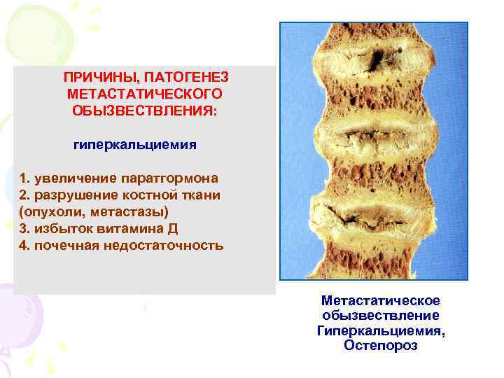 ПРИЧИНЫ, ПАТОГЕНЕЗ МЕТАСТАТИЧЕСКОГО ОБЫЗВЕСТВЛЕНИЯ: гиперкальциемия 1. увеличение паратгормона 2. разрушение костной ткани (опухоли, метастазы)
