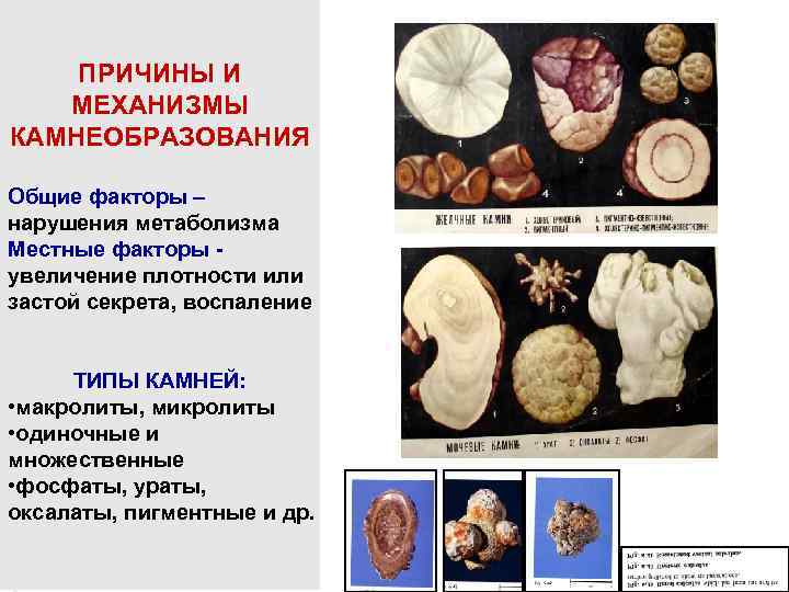 ПРИЧИНЫ И МЕХАНИЗМЫ КАМНЕОБРАЗОВАНИЯ Общие факторы – нарушения метаболизма Местные факторы увеличение плотности или