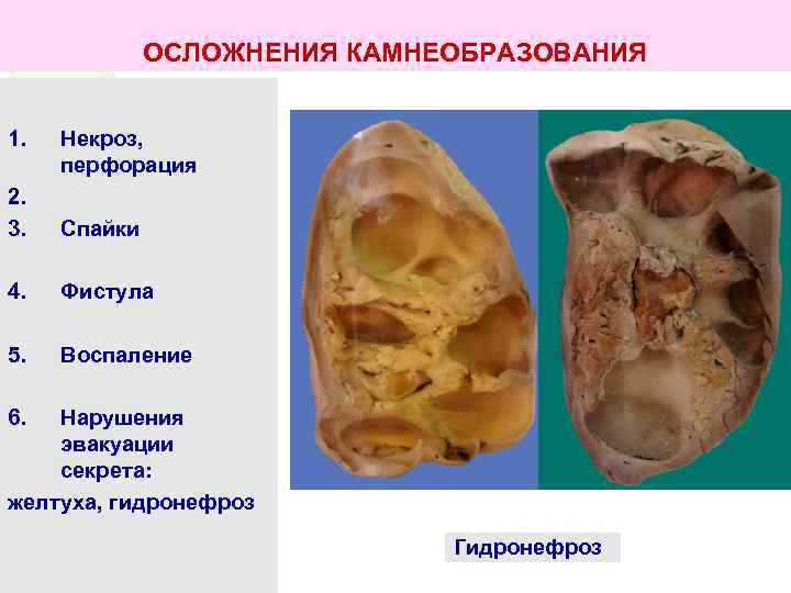ОСЛОЖНЕНИЯ КАМНЕОБРАЗОВАНИЯ 1. Некроз, перфорация 2. 3. Спайки 4. Фистула 5. Воспаление 6. Нарушения