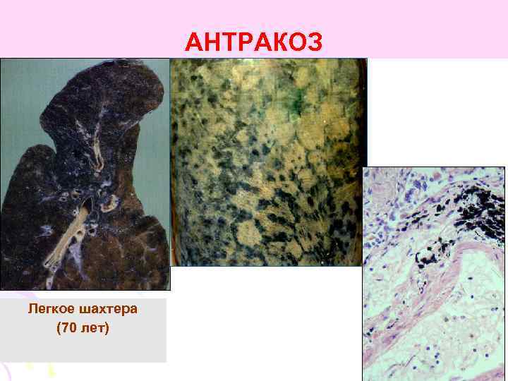 АНТРАКОЗ Легкое шахтера (70 лет) 