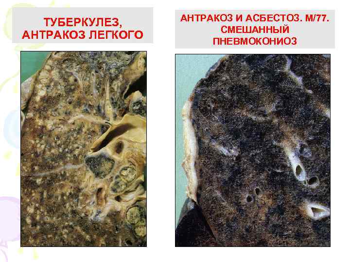 TУБЕРКУЛЕЗ, АНТРАКОЗ ЛЕГКОГО АНТРАКОЗ И АСБЕСТОЗ. М/77. СМЕШАННЫЙ ПНЕВМОКОНИОЗ 