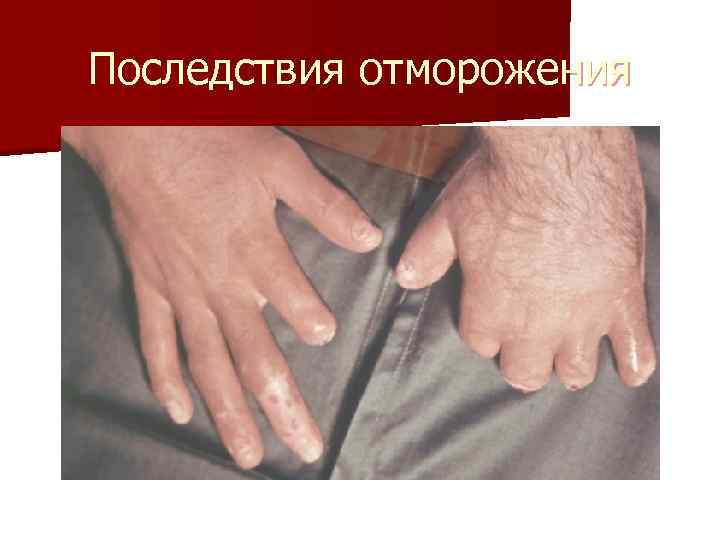 Последствия отморожения 