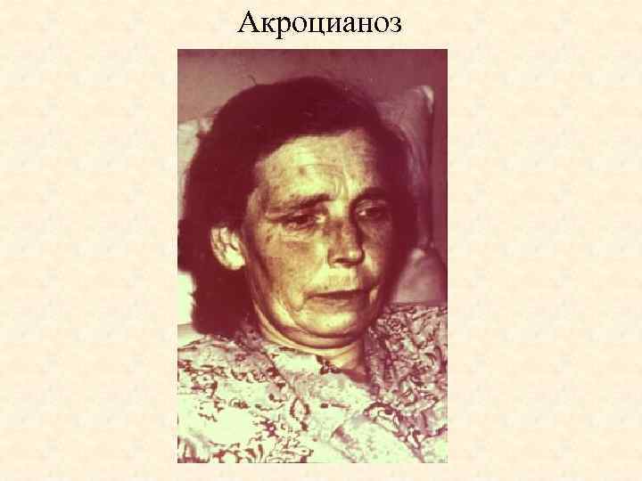 Акроцианоз 