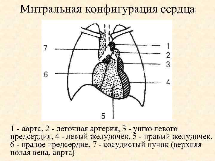 Митральная конфигурация сердца 1 - аорта, 2 - легочная артерия, 3 - ушко левого