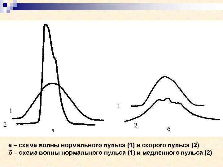 а – схема волны нормального пульса (1) и скорого пульса (2) б – схема