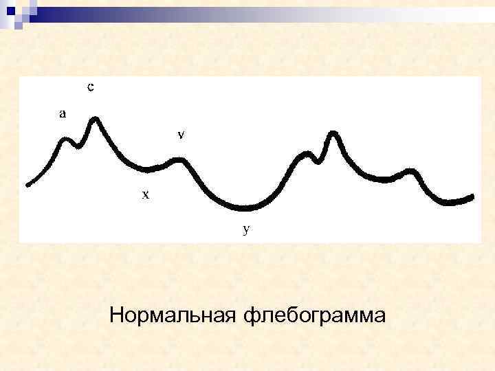 Нормальная флебограмма 