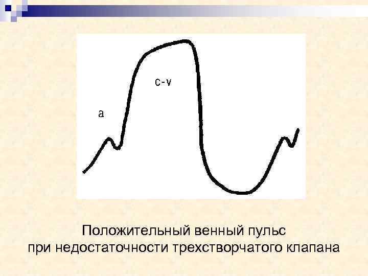 Положительный венный пульс при недостаточности трехстворчатого клапана 