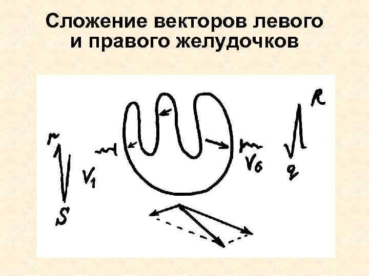 Сложение векторов левого и правого желудочков 