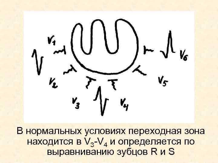 В нормальных условиях переходная зона находится в V 3 -V 4 и определяется по