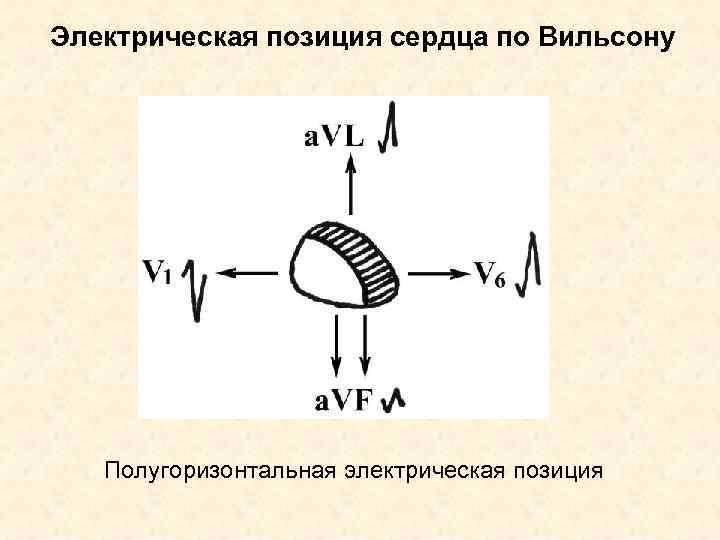 Электрическая позиция сердца по Вильсону Полугоризонтальная электрическая позиция 