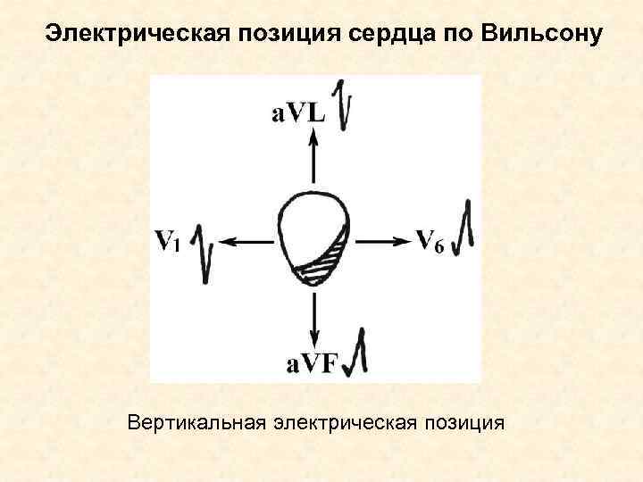 Электрическая позиция сердца по Вильсону Вертикальная электрическая позиция 
