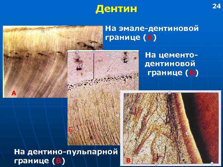 24 Дентин На эмале-дентиновой границе (А) На цементодентиновой границе (Б) А Б На дентино-пульпарной