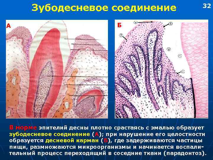 Зубодесневое соединение А 32 Б В норме эпителий десны плотно срастаясь с эмалью образует