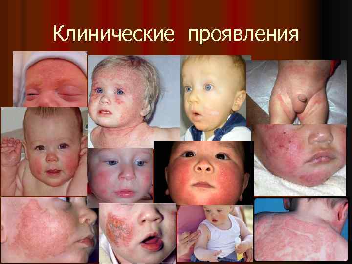 Клинические проявления 