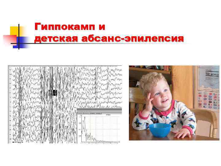 Гиппокамп и детская абсанс-эпилепсия 
