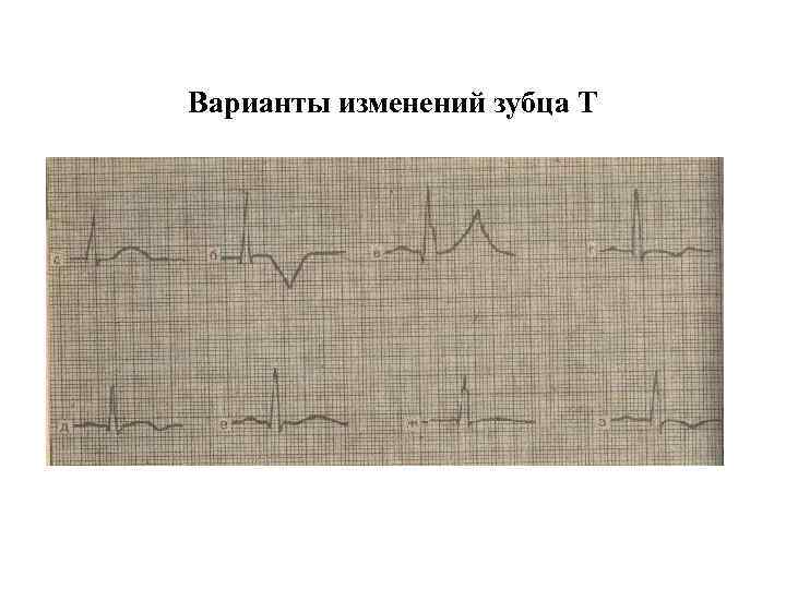 Варианты изменений зубца Т 