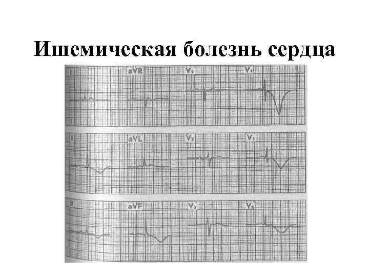 Ишемическая болезнь сердца 