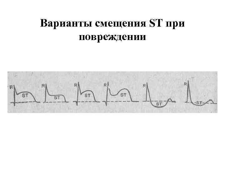 Варианты смещения ST при повреждении 