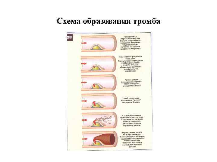Схема образования тромба 
