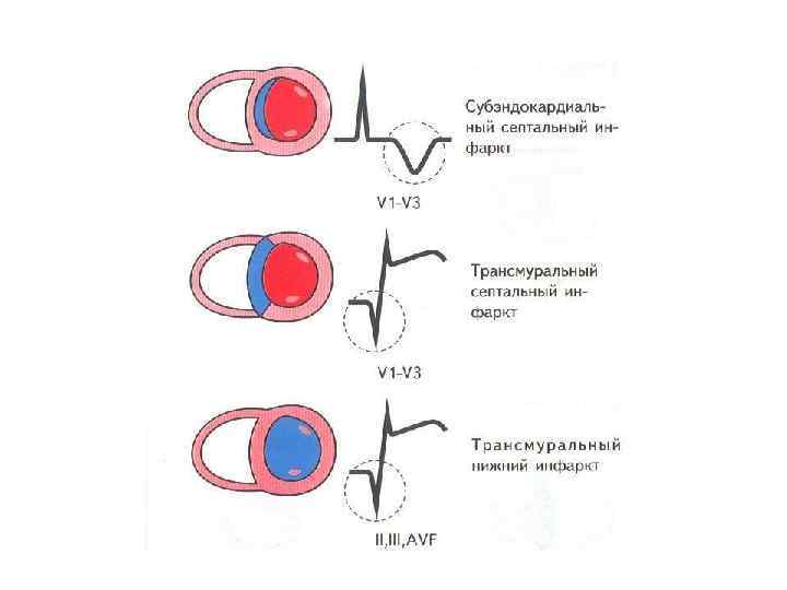 Трансмуральный инфаркт миокарда. Трансмуральный инфаркт миокарда схема. Для трансмурального инфаркта миокарда характерно. Трансмуральный инфаркт первичный. Патогенез острый трансмуральный инфаркт.