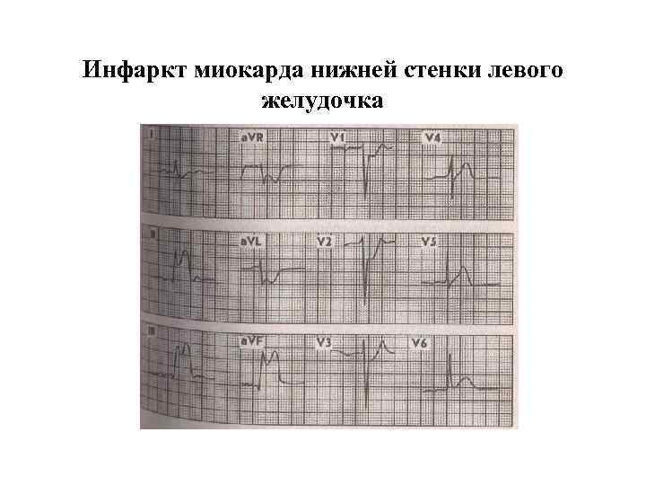 Миокард нижней стенки