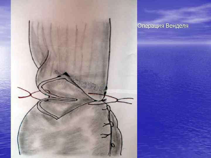 Операция Венделя 