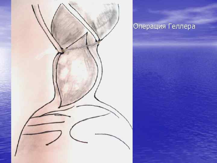 Операция Геллера 