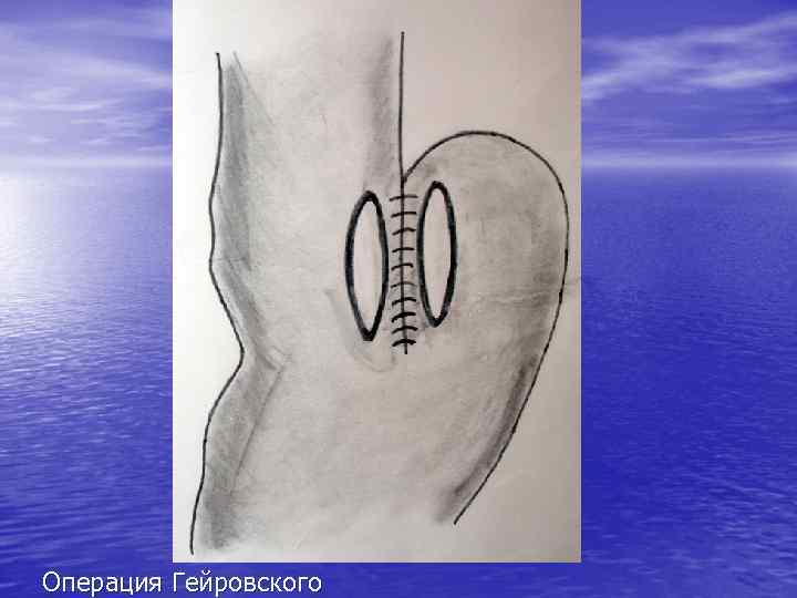 Операция Гейровского 