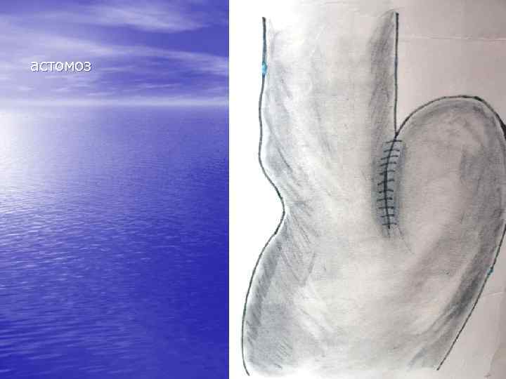 астомоз Эзофагогастроан 