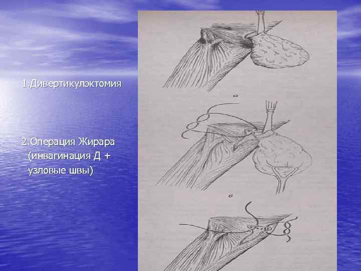 1. Дивертикулэктомия 2. Операция Жирара (инвагинация Д + узловые швы) 