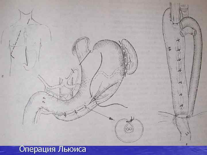 Операция Льюиса 