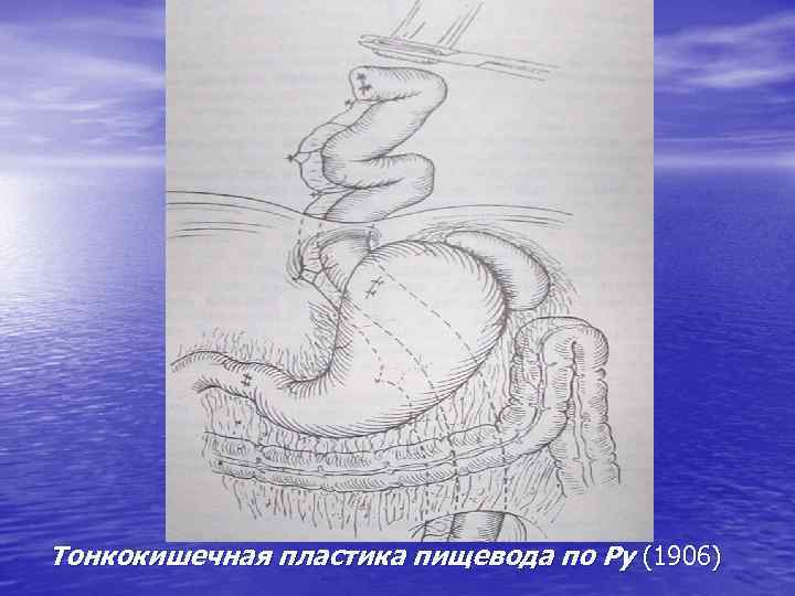 Тонкокишечная пластика пищевода по Ру (1906) 