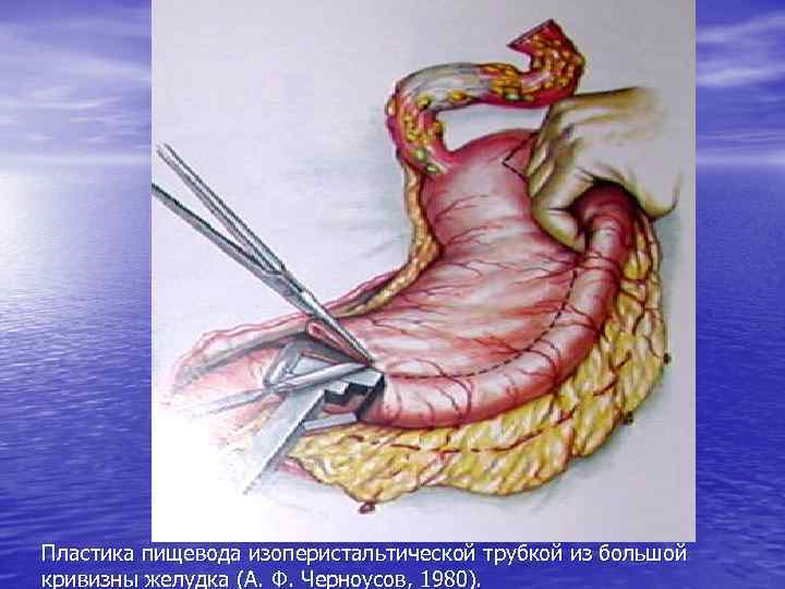 Пластика пищевода изоперистальтической трубкой из большой кривизны желудка (А. Ф. Черноусов, 1980). 