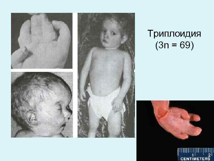 Триплоидия (3 n = 69) 
