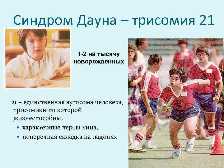 Синдром Дауна – трисомия 21 1 -2 на тысячу новорожденных 21 – единственная аутосома