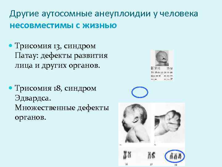 Другие аутосомные анеуплоидии у человека несовместимы с жизнью Трисомия 13, синдром Патау: дефекты развития