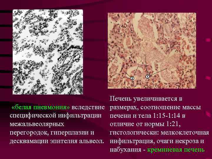 Печень увеличивается в «белая пневмония» вследствие размерах, соотношение массы специфической инфильтрации печени и тела