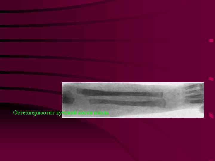 Остеопериостит лучевой кости плода 