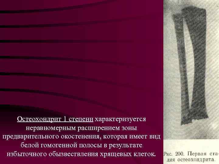 Остеохондрит 1 степени характеризуется неравномерным расширением зоны предварительного окостенения, которая имеет вид белой гомогенной