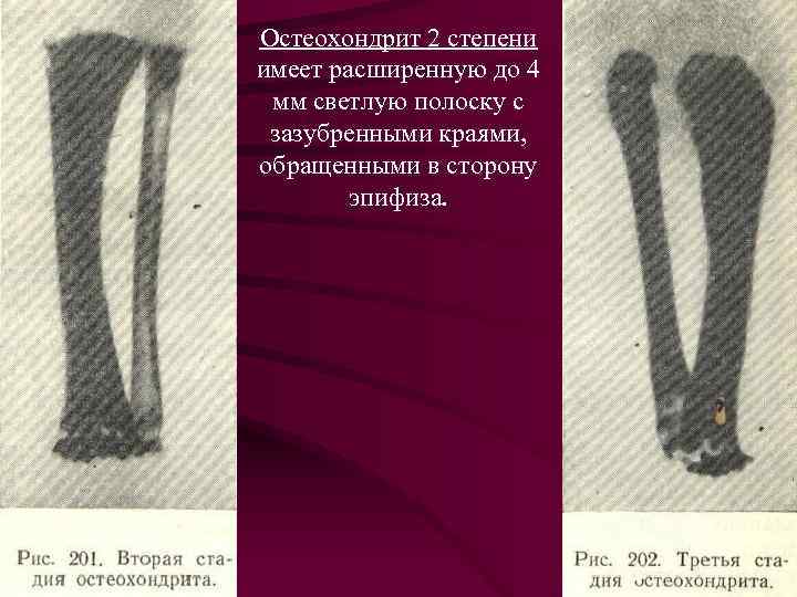 Остеохондрит 2 степени имеет расширенную до 4 мм светлую полоску с зазубренными краями, обращенными