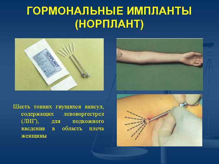 ГОРМОНАЛЬНЫЕ ИМПЛАНТЫ (НОРПЛАНТ) Шесть тонких гнущихся капсул, содержащих левоноргестрел (ЛНГ), для подкожного введения в