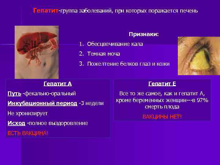 Гепатит группа заболеваний, при которых поражается печень Признаки: 1. Обесцвечивание кала 2. Темная моча