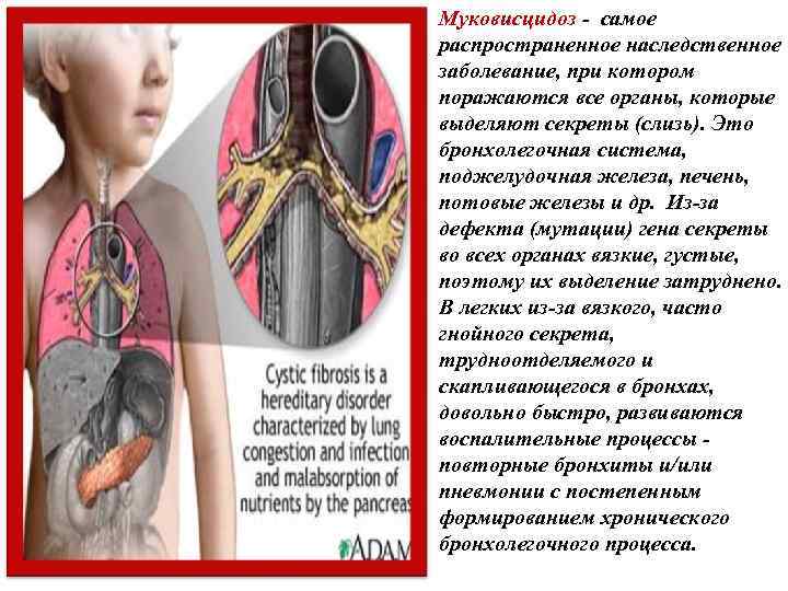 Муковисцидоз - самое распространенное наследственное заболевание, при котором поражаются все органы, которые выделяют секреты