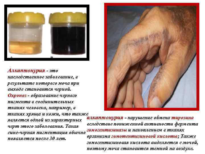 Алкаптонурия - это наследственное заболевание, в результате которого моча при выходе становится черной. Охроноз