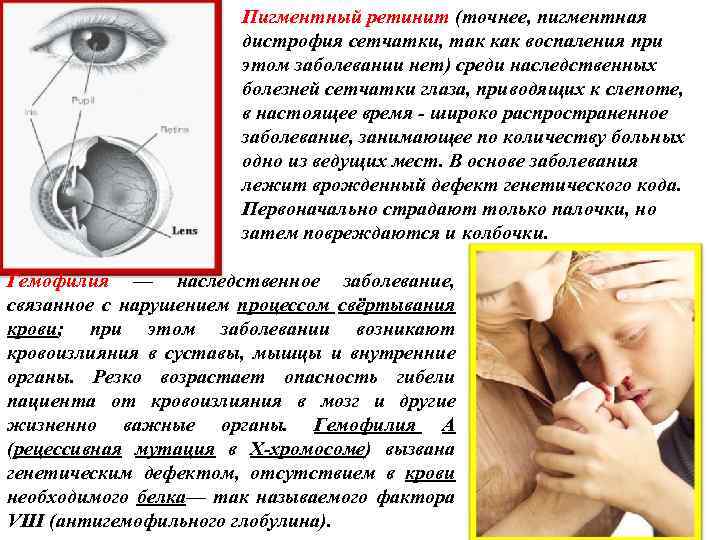 Пигментный ретинит (точнее, пигментная дистрофия сетчатки, так как воспаления при этом заболевании нет) среди