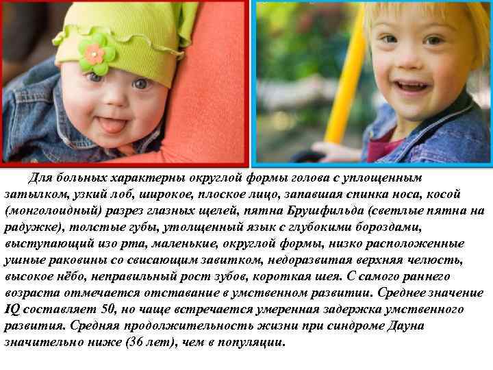 Для больных характерны округлой формы голова с уплощенным затылком, узкий лоб, широкое, плоское лицо,