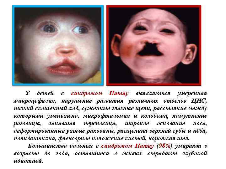 У детей с синдромом Патау выявляются умеренная микроцефалия, нарушение развития различных отделов ЦНС, низкий
